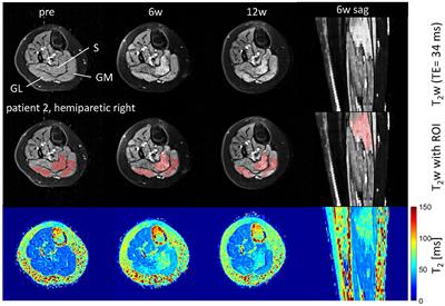 Quantification and Monitoring of the Effect of Botulinum Toxin A on Paretic Calf Muscles of Children With Cerebral Palsy With MRI: A Preliminary Study